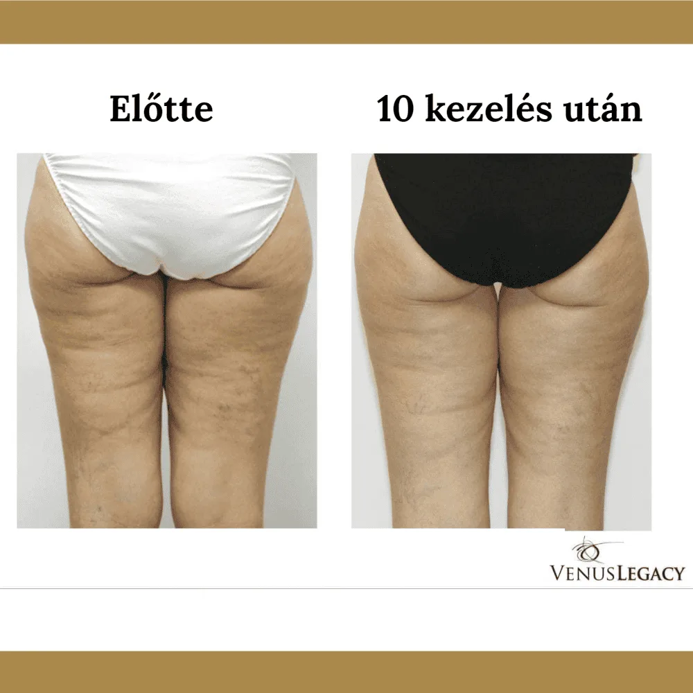 Venus Legacy előtte-utána eredmény 1