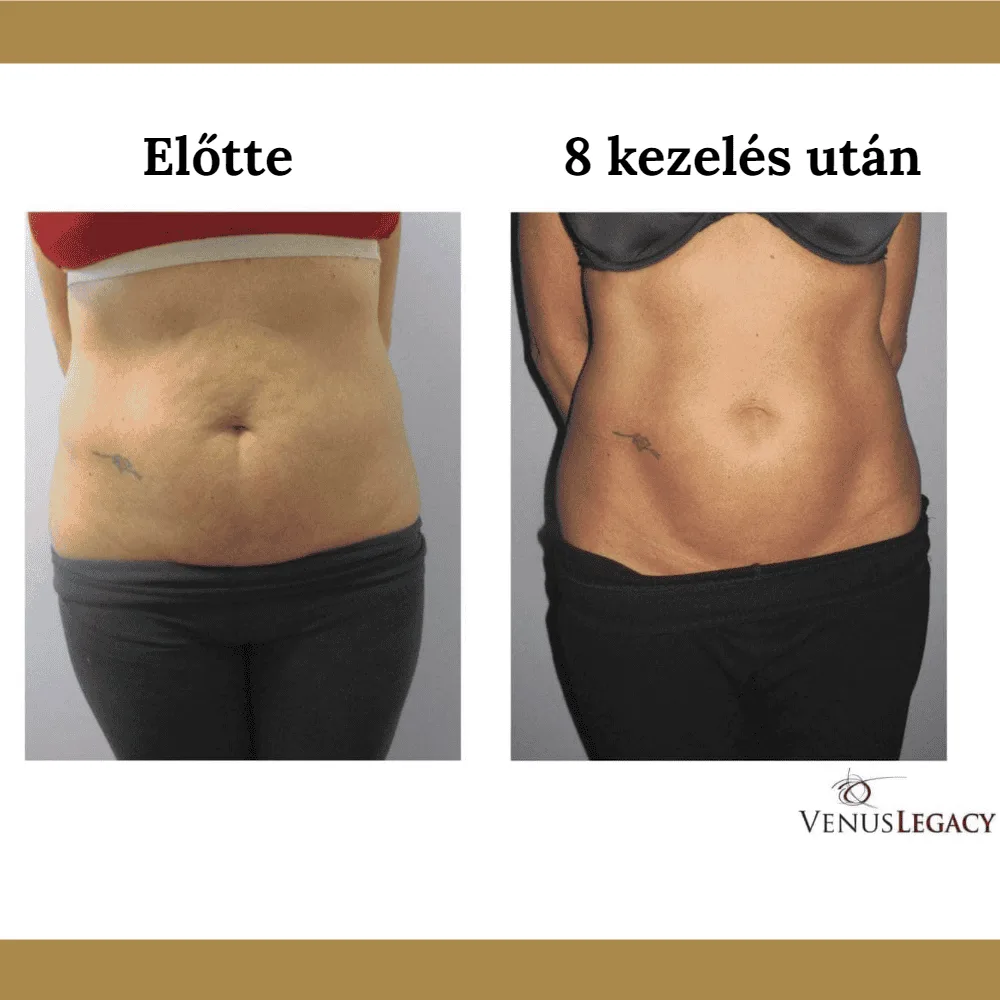 Venus Legacy előtte-utána eredmény 2