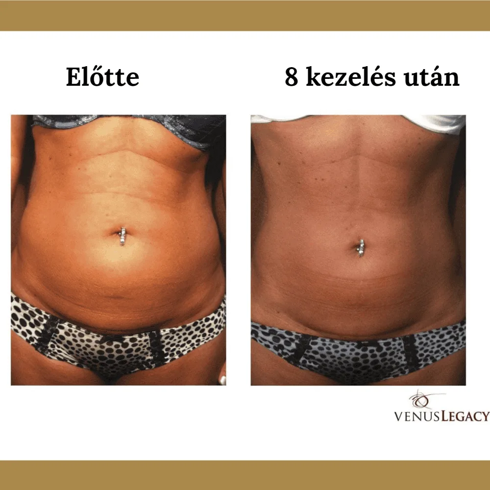 Venus Legacy előtte-utána eredmény 3
