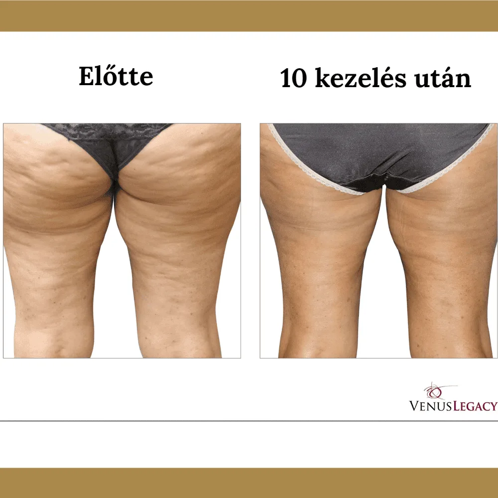 Venus Legacy előtte-utána eredmény 4
