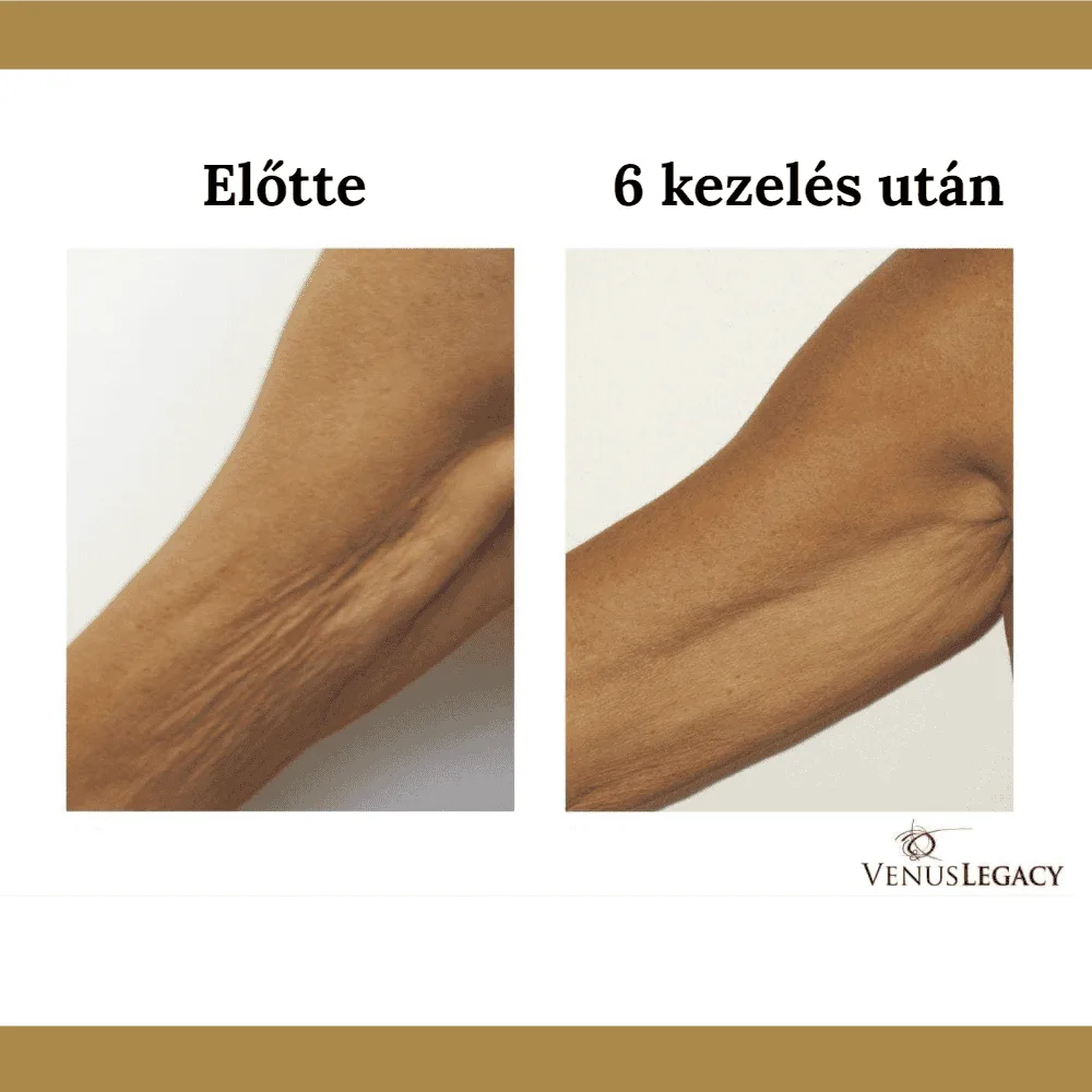 Venus Legacy előtte-utána eredmény 5