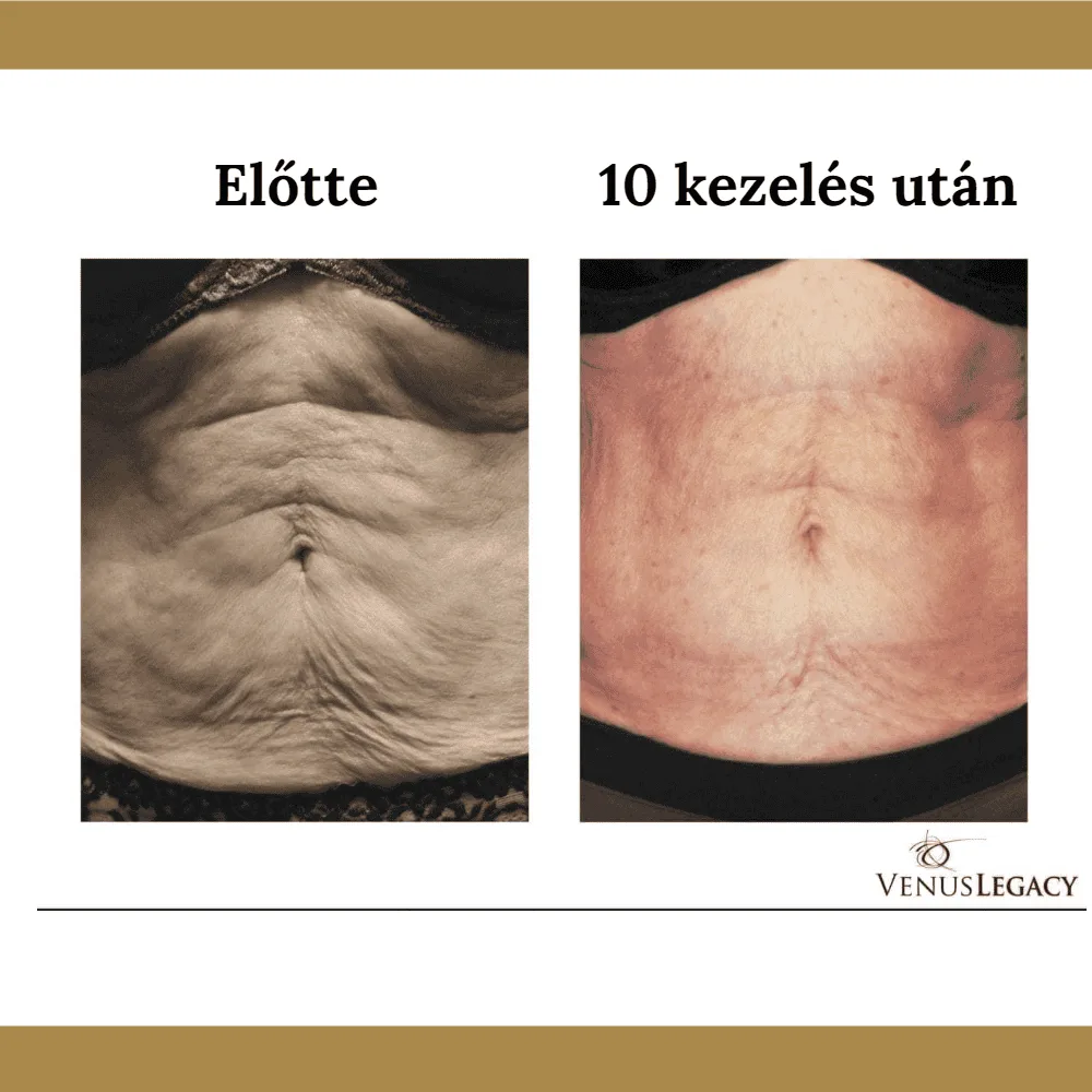 Venus Legacy előtte-utána eredmény 6