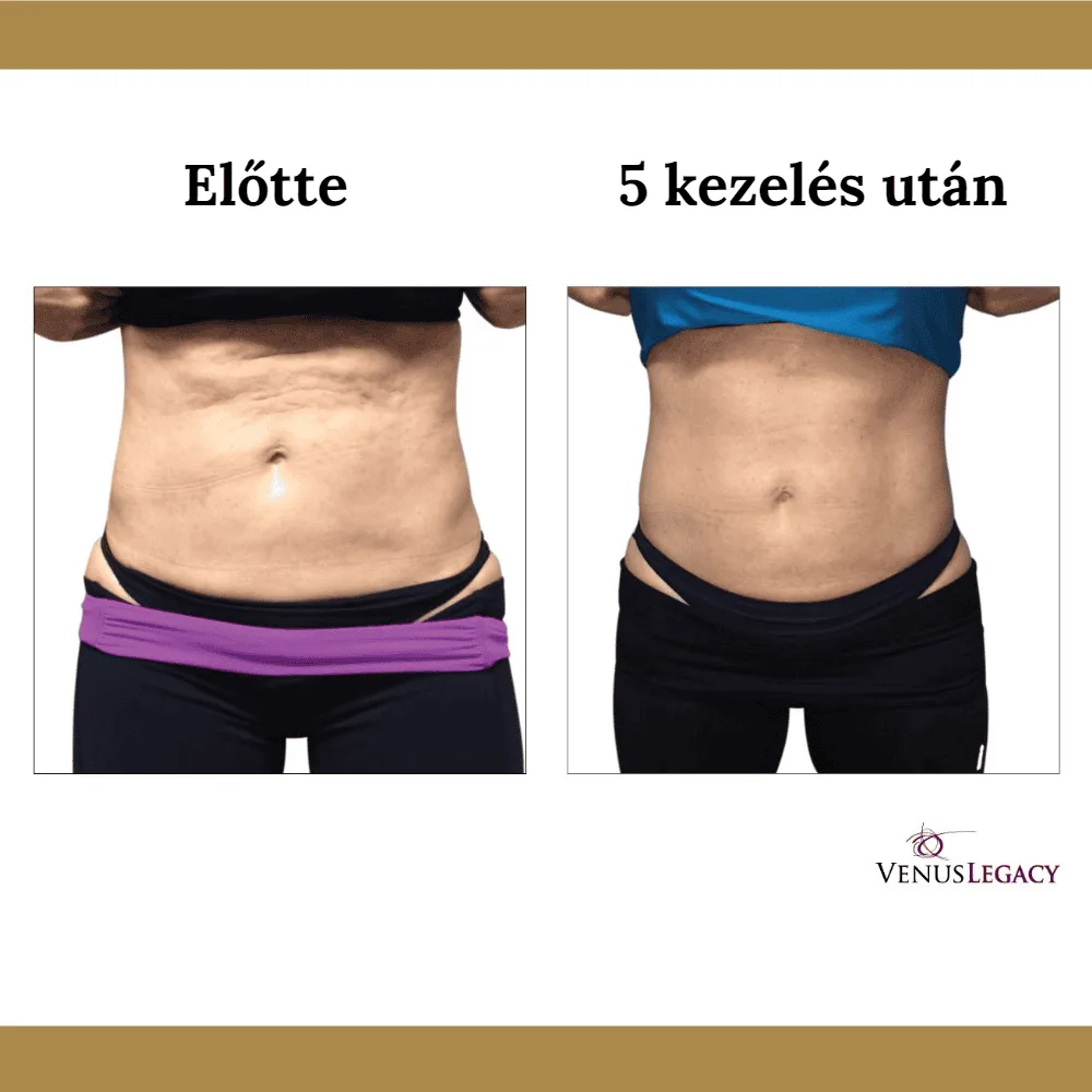 Venus Legacy előtte-utána eredmény 7