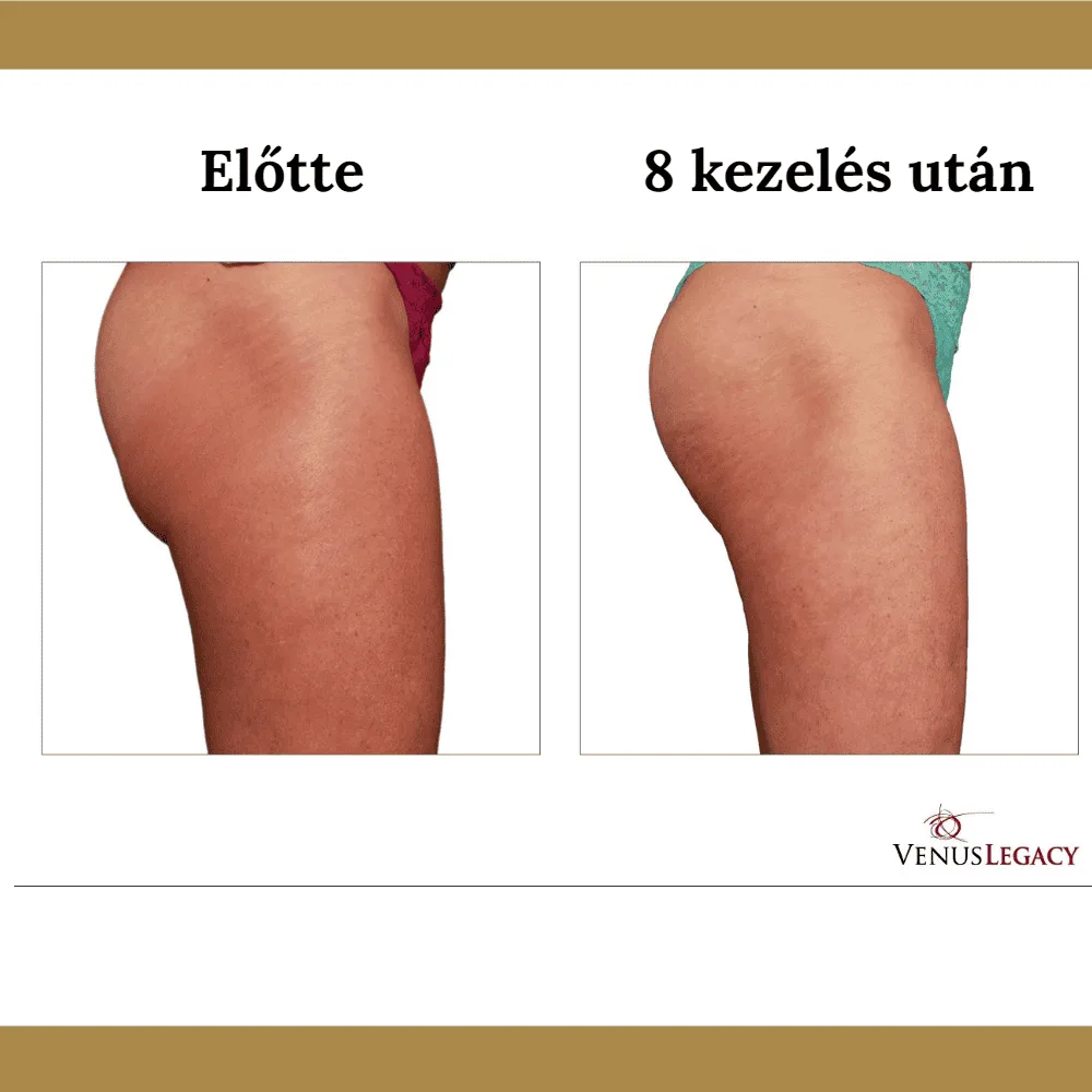 Venus Legacy előtte-utána eredmény 8