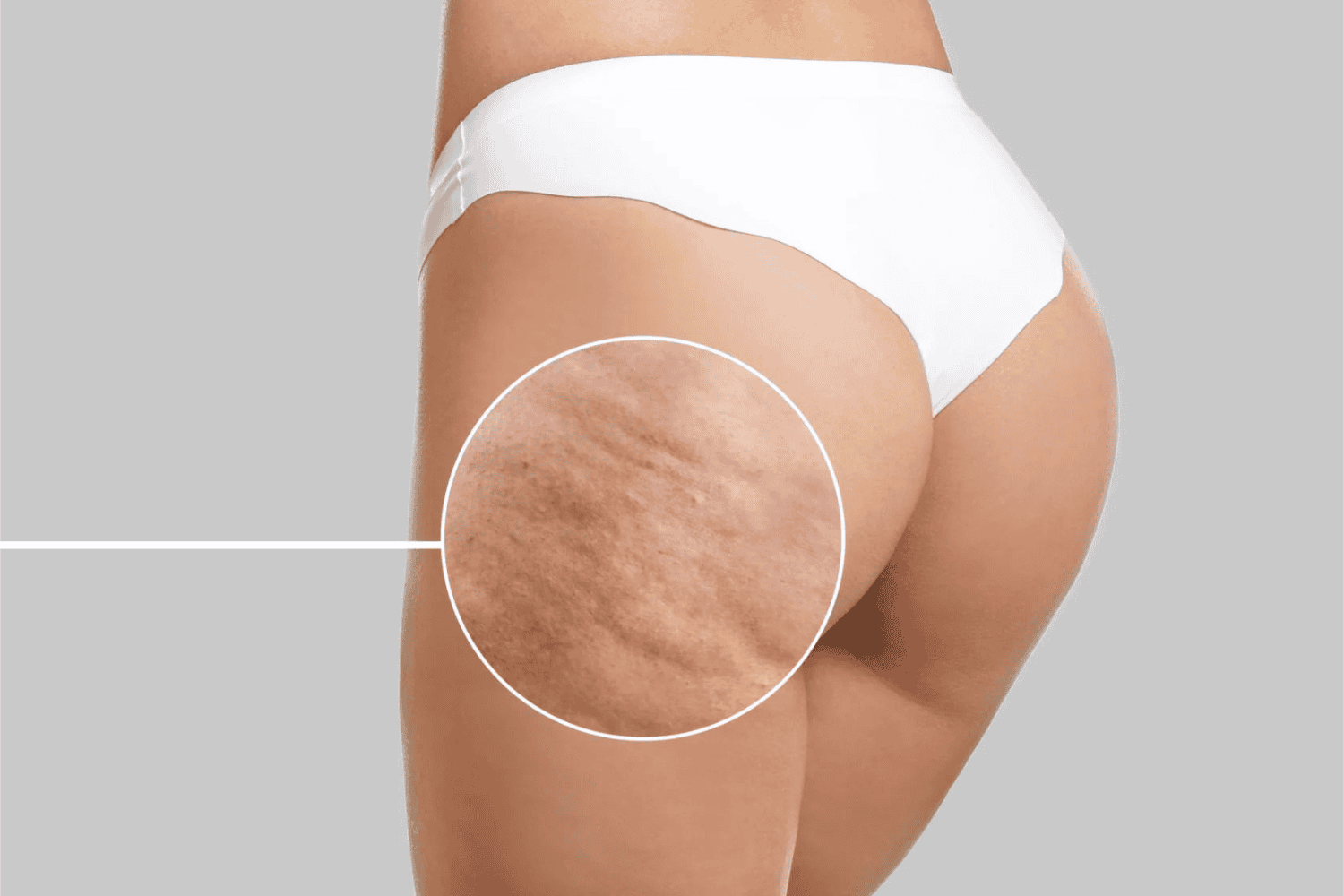Narancsbőr kezelése – Otthon és profi szalonban